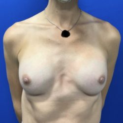 Breast Augmentation Before & After Patient #2666