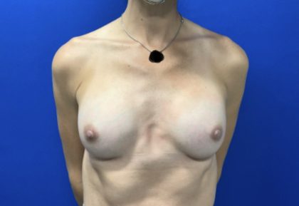 Breast Augmentation Before & After Patient #2666