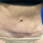 Tummy Tuck Before & After Patient #2547