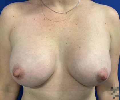 Breast Augmentation Before & After Patient #2671