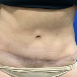 Tummy Tuck Before & After Patient #2549