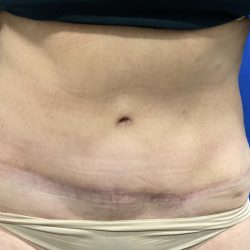 Tummy Tuck Before & After Patient #2549