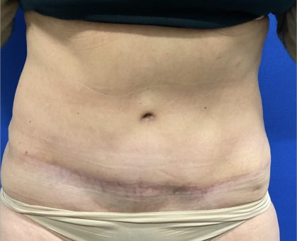 Tummy Tuck Before & After Patient #2549