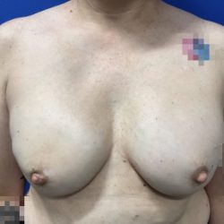Breast Reconstruction with Direct to Implant with Silicone Implants Before & After Patient #2701