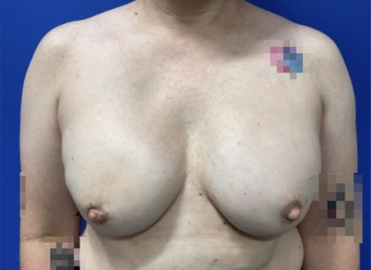 Breast Reconstruction with Direct to Implant with Silicone Implants Before & After Patient #2701