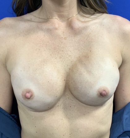 Breast Reconstruction with Direct to Implant with Silicone Implants Before & After Patient #2702