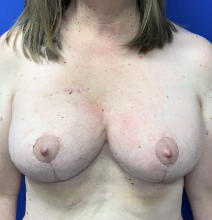 Breast Reduction With Galaflex Before & After Patient #2728