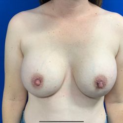 Breast Augmentation Before & After Patient #2635