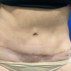 Tummy Tuck Before & After Patient #2547