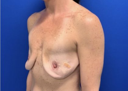 Implant Revision/Removal Before & After Patient #2839