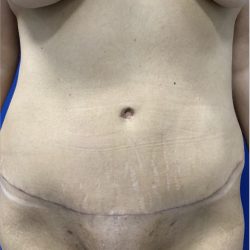 Tummy Tuck Before & After Patient #2550