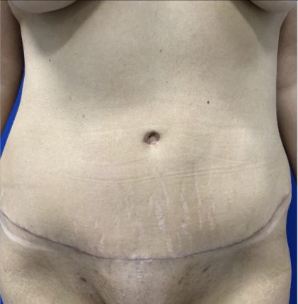Tummy Tuck Before & After Patient #2550