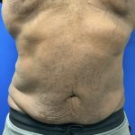 Emsculpt Neo Before & After Patient #2793