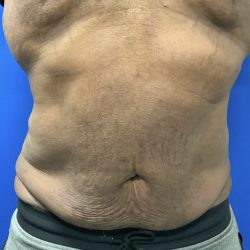 Emsculpt Neo Before & After Patient #2793