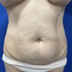 Wellness Program Before & After Patient #2800