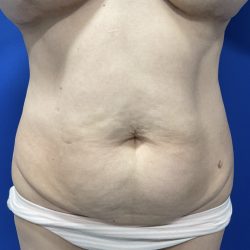 Wellness Program Before & After Patient #2800
