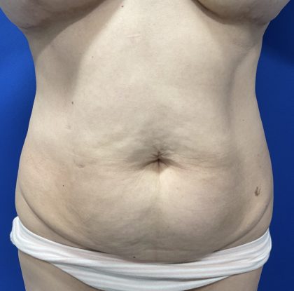 Wellness Program Before & After Patient #2800