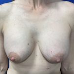 Implant Exchange Due to Ruptured Silicone Before & After Patient #2811