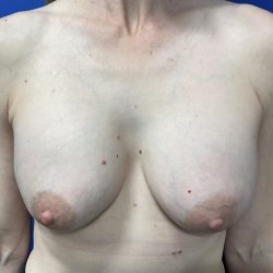 Implant Exchange Due to Ruptured Silicone Before & After Patient #2811