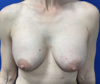 Implant Exchange Due to Ruptured Silicone Before & After Patient #2811