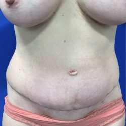 Tummy Tuck Before & After Patient #2551