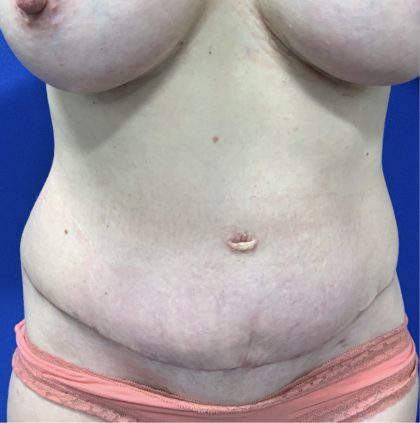 Tummy Tuck Before & After Patient #2551