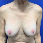 Implant Exchange With Capsulectomy Before & After Patient #2853