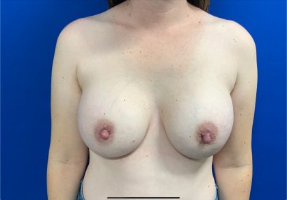 Breast Augmentation Before & After Patient #2635