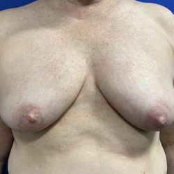 Inverted Nipple Correction with Galaflex Before & After Patient #2875