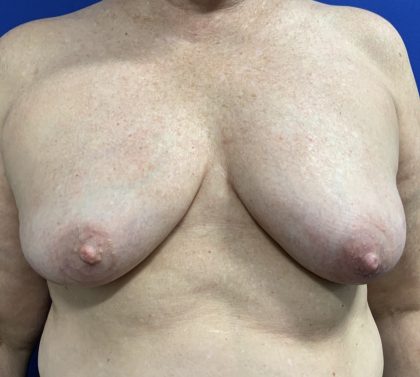 Inverted Nipple Correction with Galaflex Before & After Patient #2875