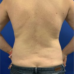 Liposuction Before & After Patient #2887