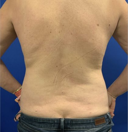 Liposuction Before & After Patient #2887