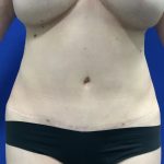 Liposuction Before & After Patient #2888