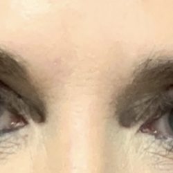Blepharoplasty Before & After Patient #2586