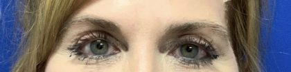 Blepharoplasty Before & After Patient #2586
