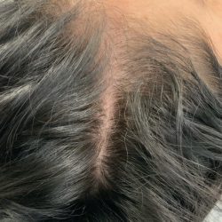 PRP For Hair Restoration Before & After Patient #2902