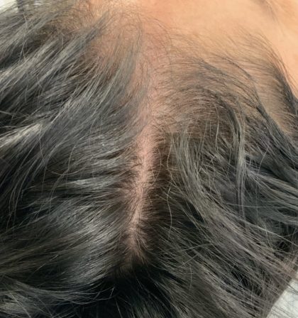 PRP For Hair Restoration Before & After Patient #2902