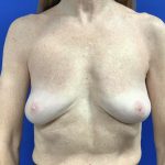 Implant Removal with Capsulectomy Before & After Patient #2910