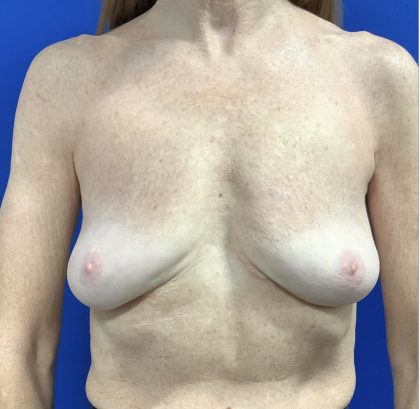 Implant Removal with Capsulectomy Before & After Patient #2910