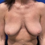 Implant Removal with Capsulectomy Before & After Patient #2912