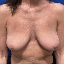 Implant Removal with Capsulectomy Before & After Patient #2912