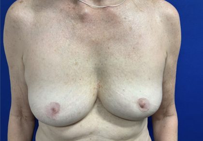 Implant Removal with Capsulectomy Before & After Patient #2914