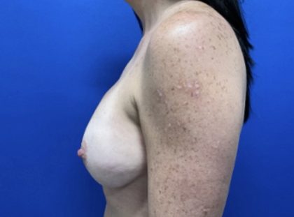 Implant Revision/Removal Before & After Patient #2839