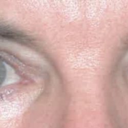 Blepharoplasty Before & After Patient #2587
