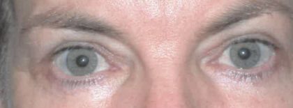 Blepharoplasty Before & After Patient #2587