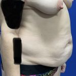 Tummy Tuck Before & After Patient #2548
