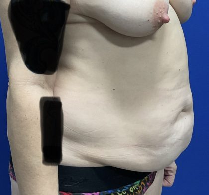 Tummy Tuck Before & After Patient #2548