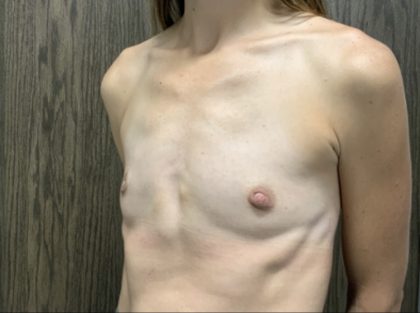 Breast Augmentation Before & After Patient #2666