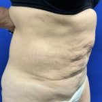 Tummy Tuck Before & After Patient #2547