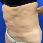 Tummy Tuck Before & After Patient #2549
